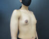 Breast Augmentation case #5010