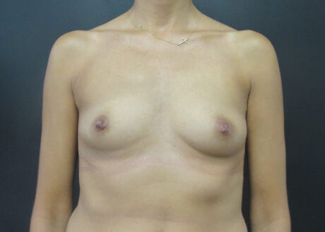 Breast Augmentation case #5032