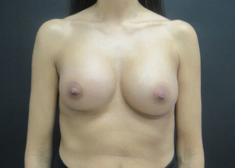 Breast Augmentation case #5032