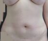 Tummy Tuck case #5003