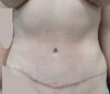 Tummy Tuck case #5003