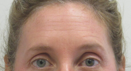 BOTOX® Cosmetic case #5056