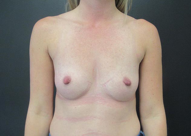 Breast Augmentation