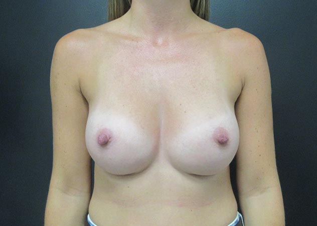 Breast Augmentation case #5066