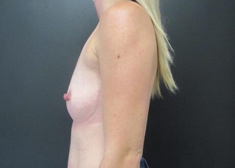 Breast Augmentation case #5066