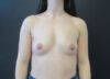 Breast Augmentation case #5085