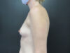Breast Augmentation case #5124
