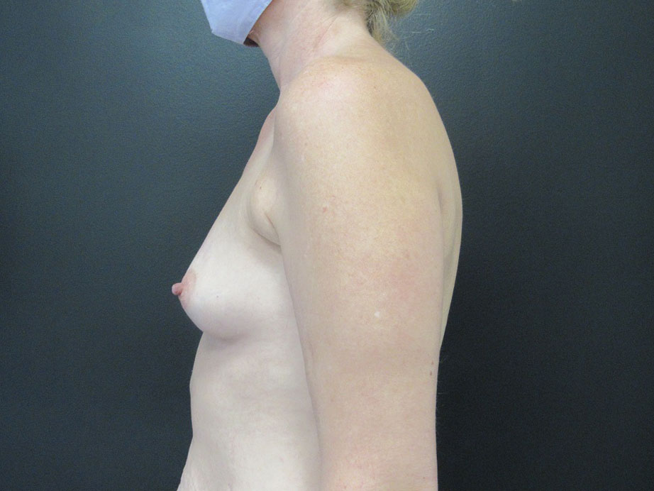 Breast Augmentation case #5124