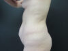 Tummy Tuck case #5131