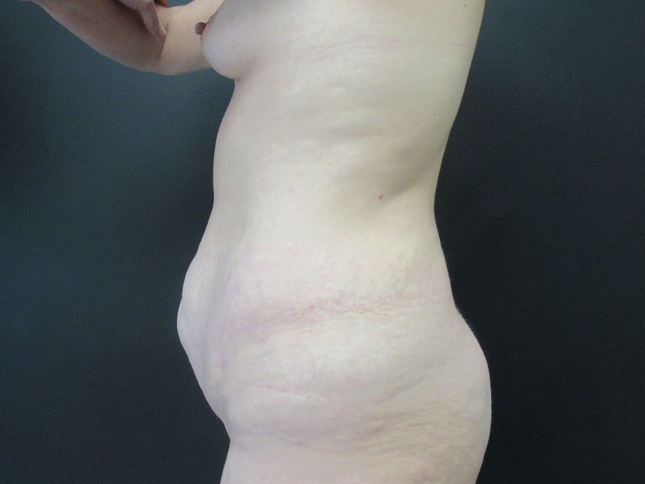 Tummy Tuck