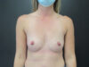 Breast Augmentation case #5154