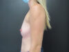 Breast Augmentation case #5154