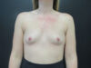 Breast Augmentation case #5163