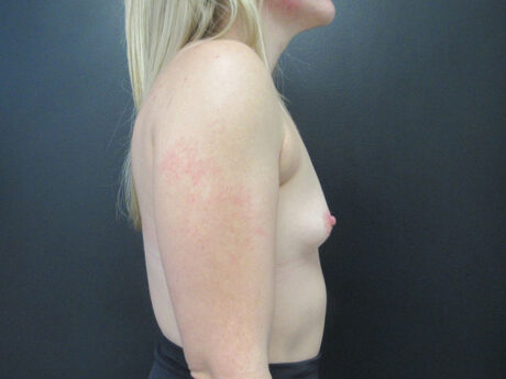 Breast Augmentation case #5163