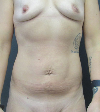 Tummy Tuck case #5182