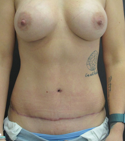 Tummy Tuck case #5182