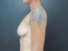 Breast Augmentation case #5215