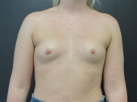 Breast Augmentation case #5237