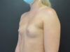 Breast Augmentation case #5237