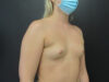 Breast Augmentation case #5237