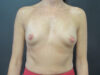 Breast Augmentation case #5245