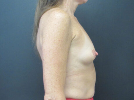 Breast Augmentation case #5245