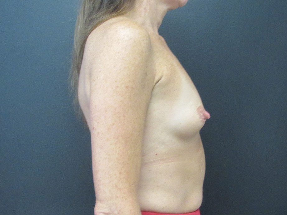Breast Augmentation