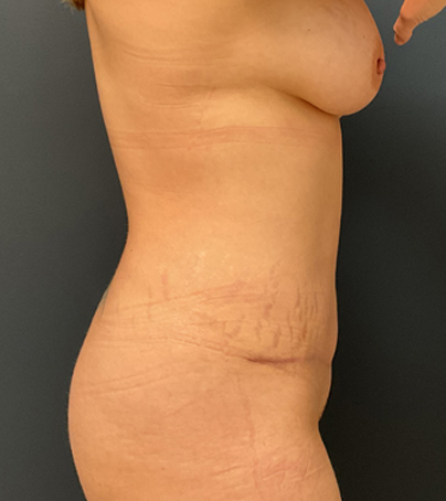 Breast Augmentation case #5289