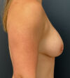 Breast Augmentation case #5289