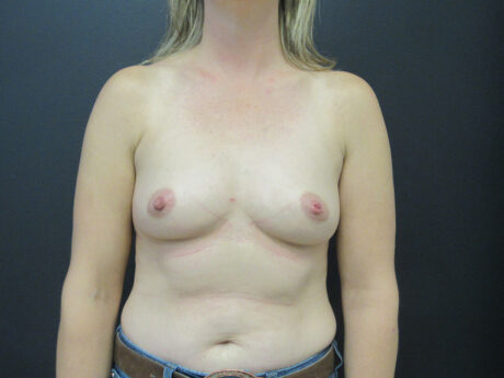 Breast Augmentation case #5267