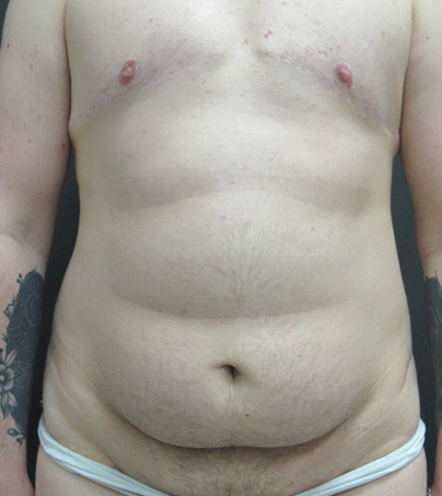 Tummy Tuck case #5311