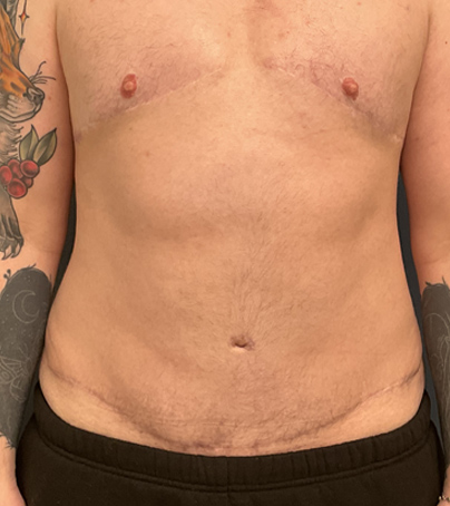 Tummy Tuck case #5311