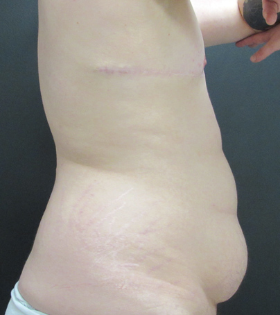 Tummy Tuck case #5311