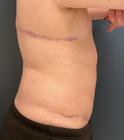 Tummy Tuck case #5311