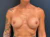 Breast Revision case #5326