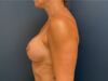 Breast Revision case #5326