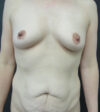 Tummy Tuck case #5347