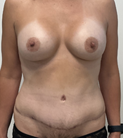 Breast Augmentation case #5333