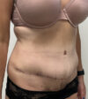 Breast Augmentation case #5333