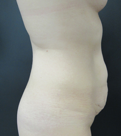 Tummy Tuck case #5347