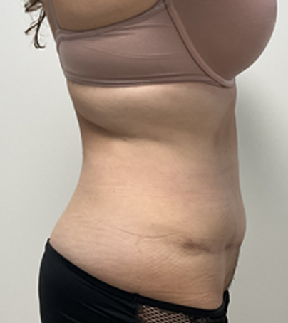 Tummy Tuck case #5347