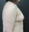 Breast Augmentation case #5373