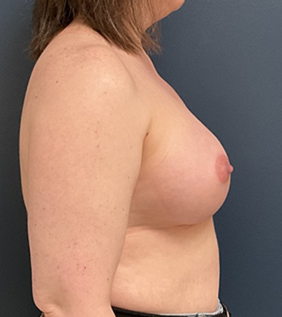 Breast Augmentation case #5373