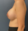 Breast Augmentation case #5387