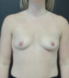 Breast Augmentation case #5394