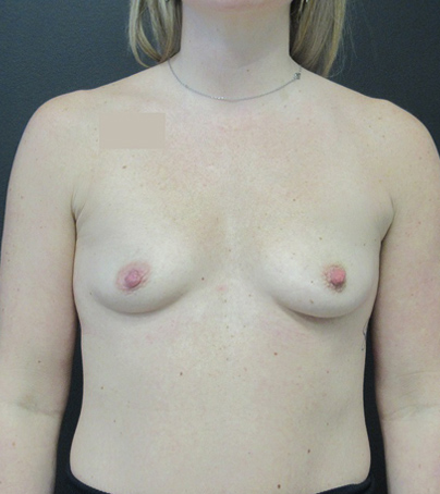 Breast Augmentation case #5394