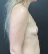 Breast Augmentation case #5394