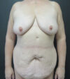 Tummy Tuck case #5510