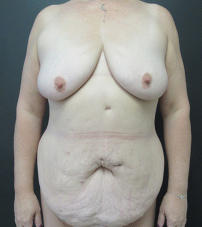 Breast Augmentation With Lift case #5503