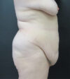 Tummy Tuck case #5510